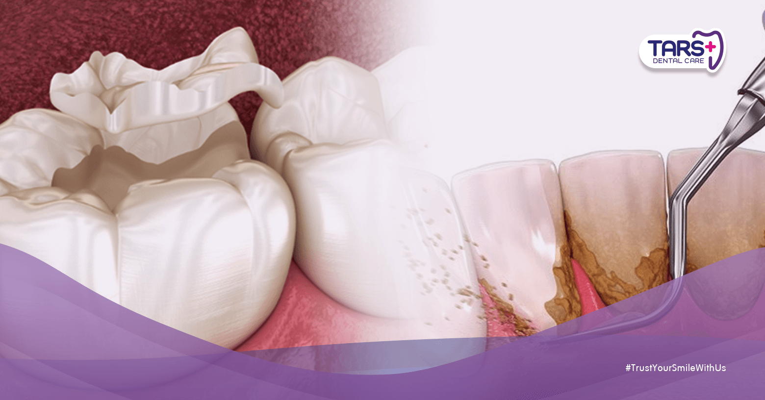 Scaling vs Tambal Gigi, Mana Dulu?