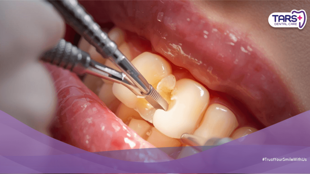 Bolehkah Tambal Gigi Saat Puasa? Berikut Penjelasan Lengkapnya