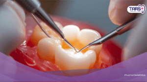 Harga Tambal Gigi Terbaru: Jenis Tambalan dan Harganya