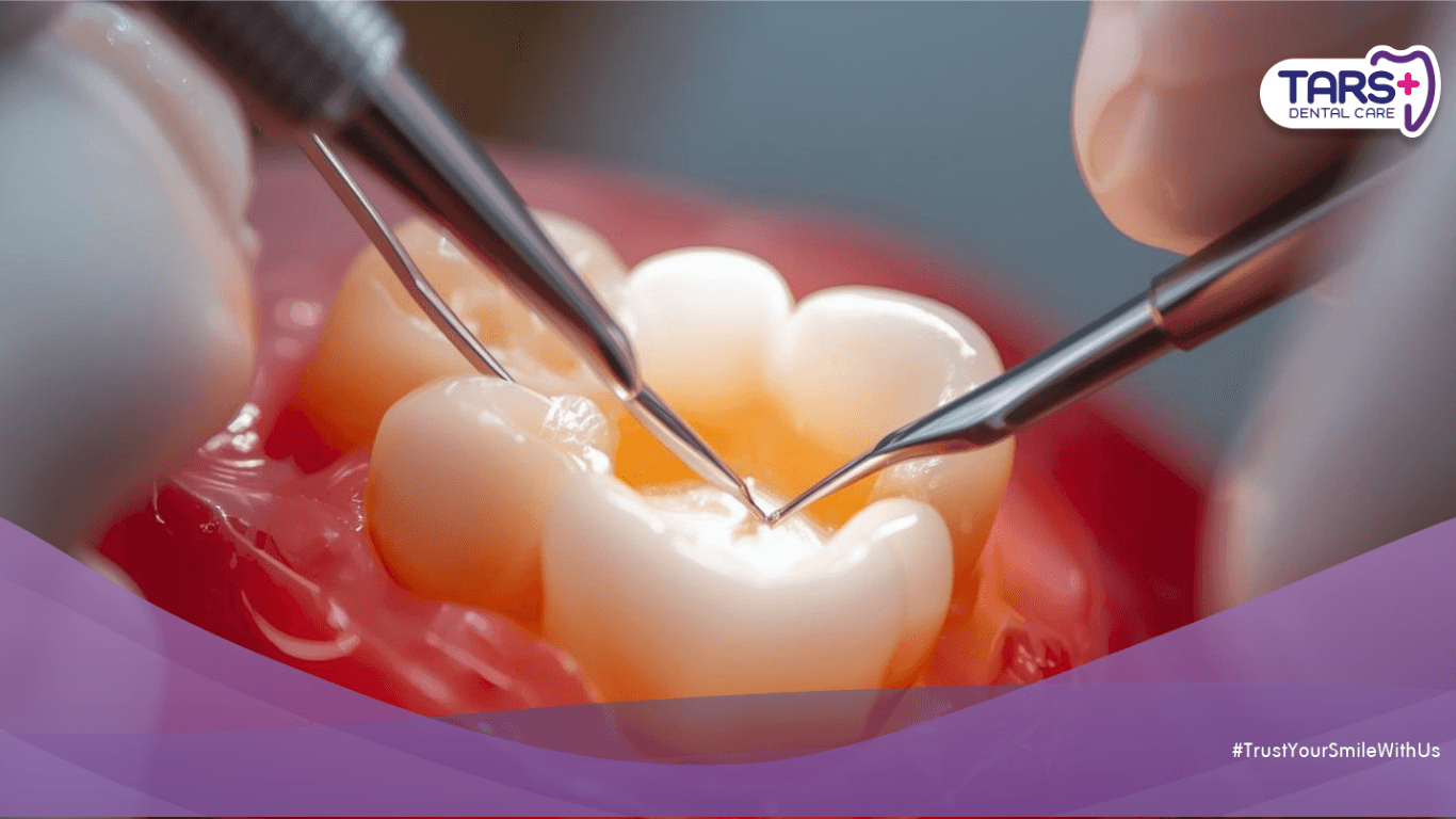 Harga Tambal Gigi Terbaru: Jenis Tambalan dan Harganya