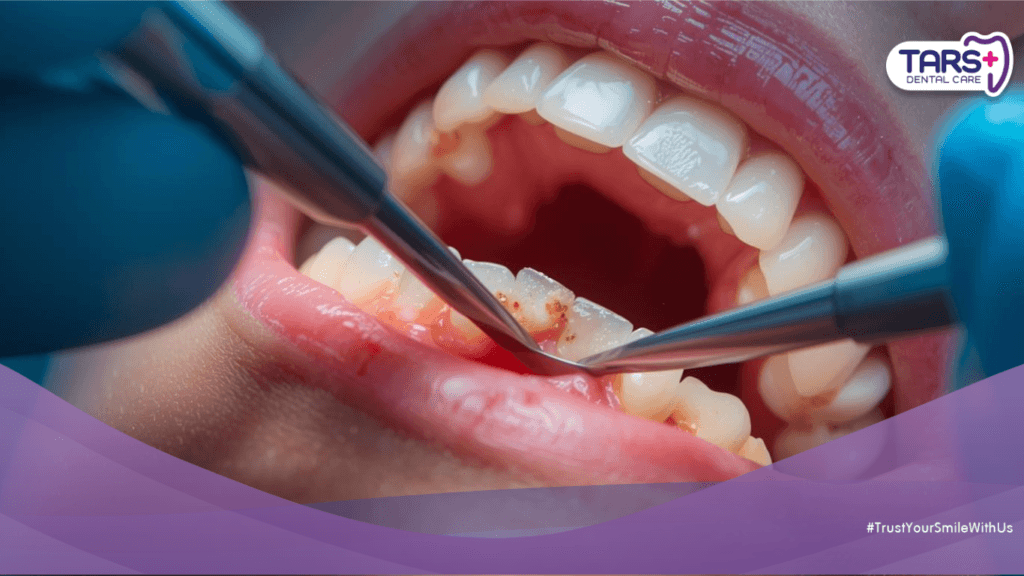 Scaling Gigi Saat Puasa Apakah Membatalkan? Ini Faktanya