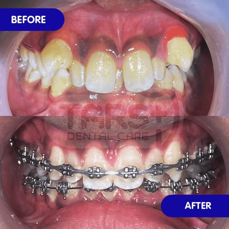 Behel Gigi TARS Dental Care (Before-After)