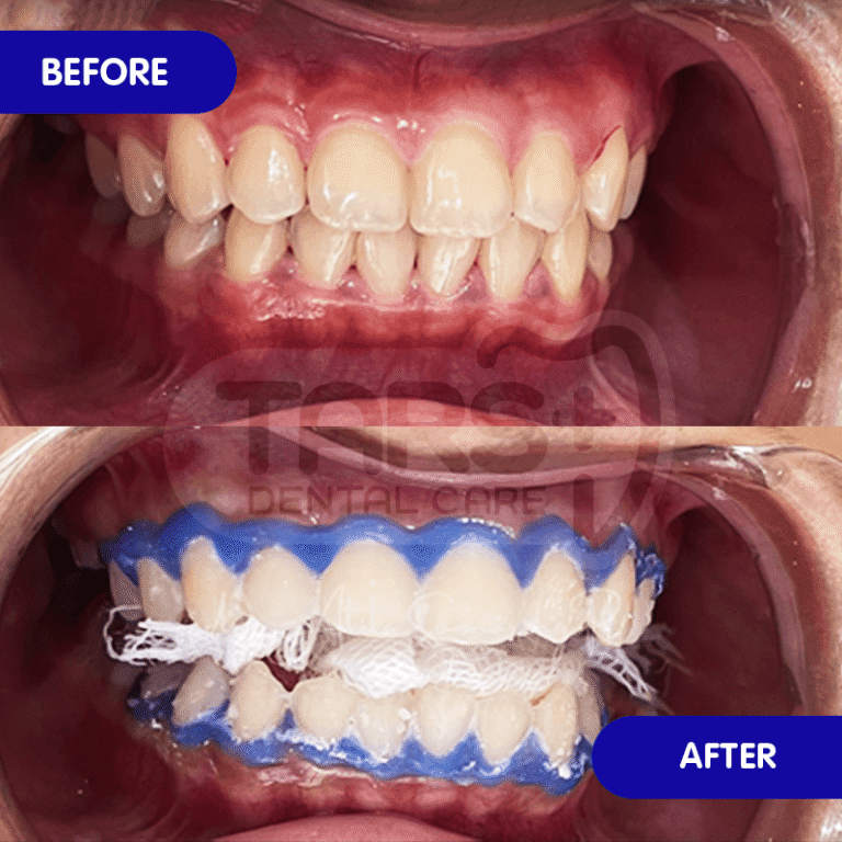 Bleaching Gigi TARS Dental Care (Before-After)