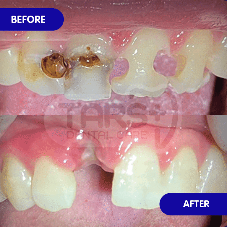 Cabut Gigi TARS Dental Care (Before-After)