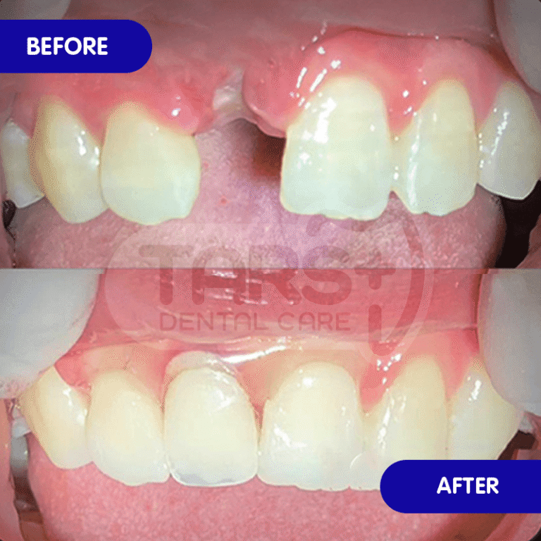 Gigi Palsu TARS Dental Care (Before-After)