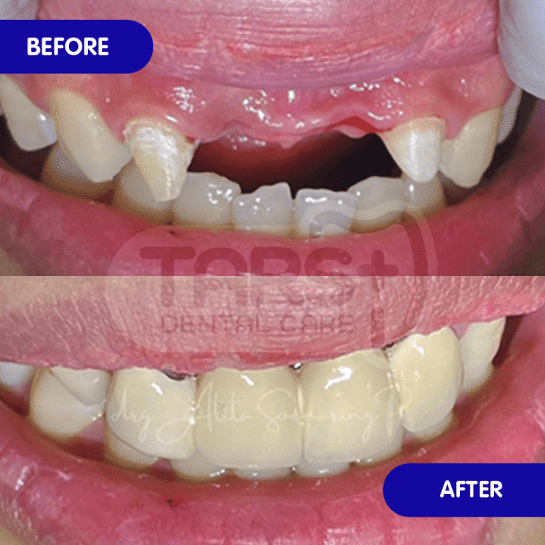Implan Gigi TARS Dental Care (Before-After)