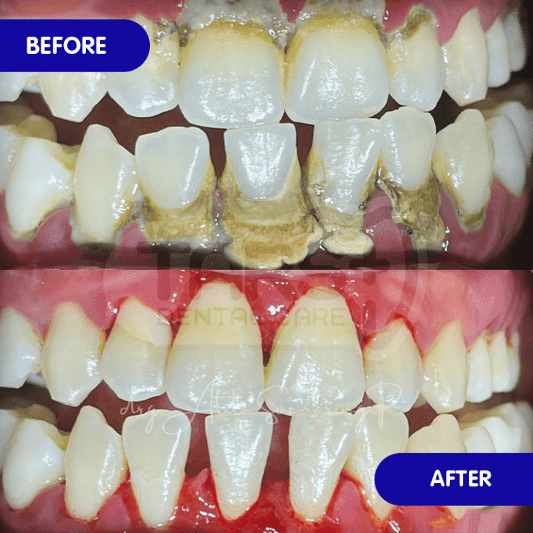 Scaling Gigi TARS Dental Care (Before-After)