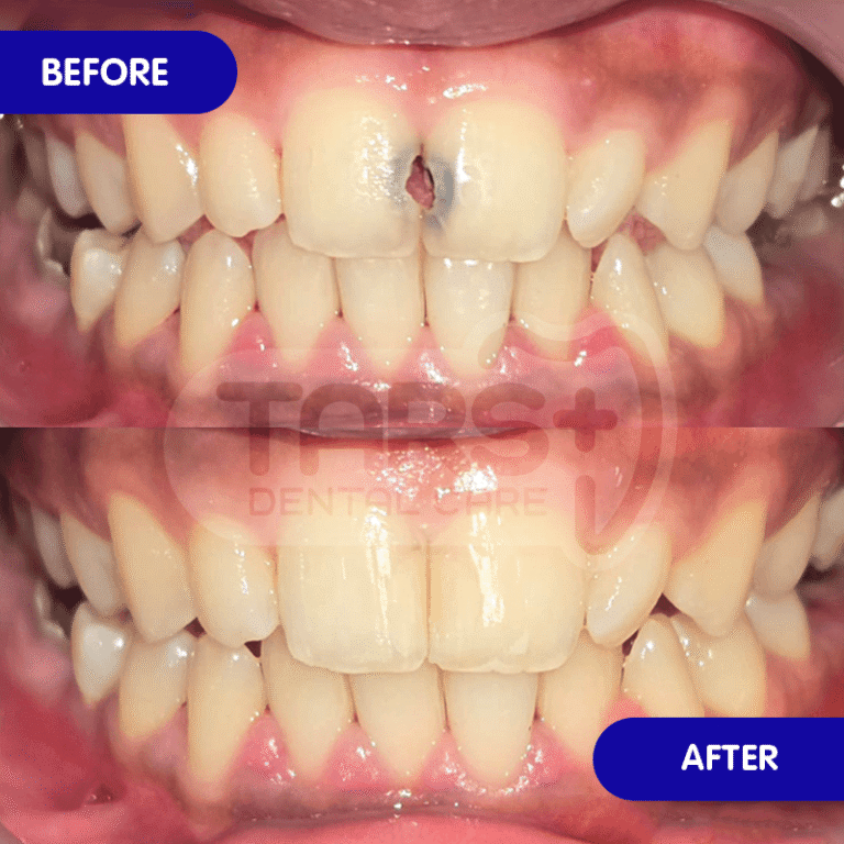 Tambal Gigi TARS Dental Care (Before-After)