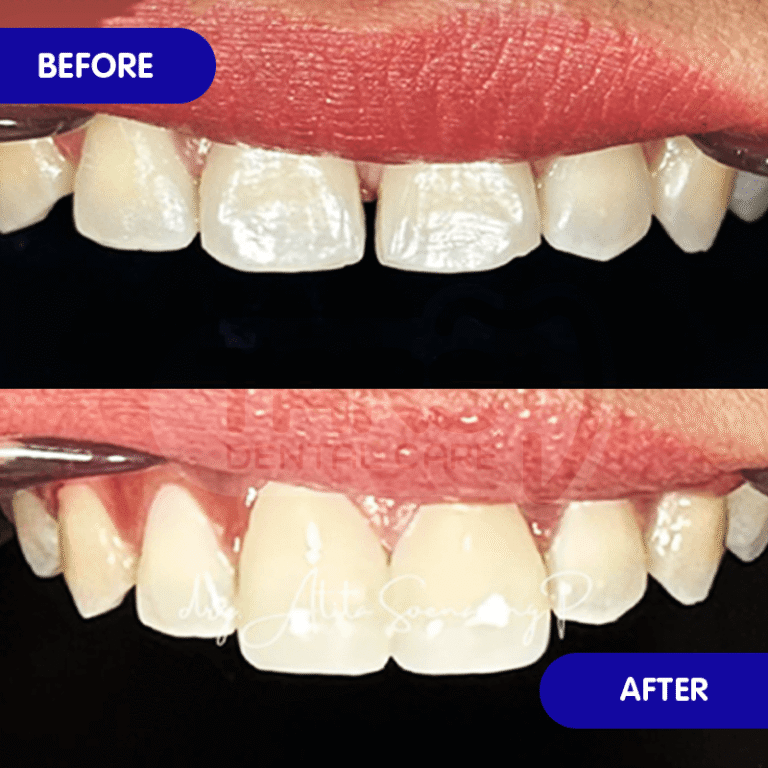Veneer Gigi TARS Dental Care (Before-After)